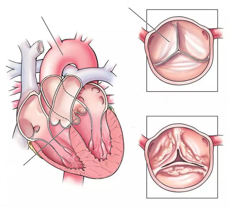 aortic valve stenosis image
